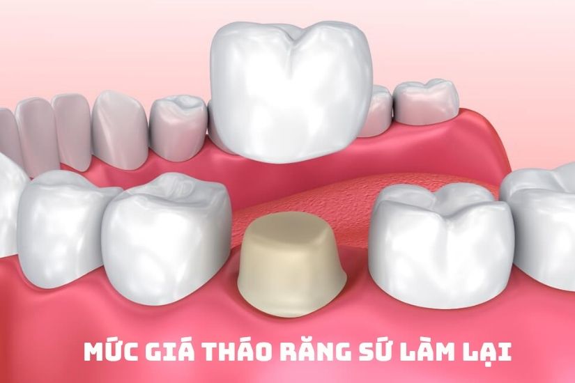 Mức giá khi tháo răng sứ làm lại