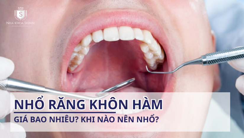 Nhổ răng khôn hàm trên giá bao nhiêu? Khi nào nên nhổ?