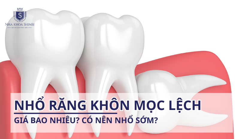 Nhổ răng khôn mọc lệch giá bao nhiêu? Có nên nhổ sớm?