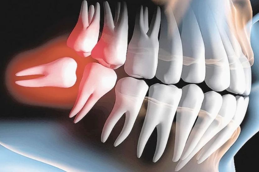 Những bất tiện mà răng khôn mang lại