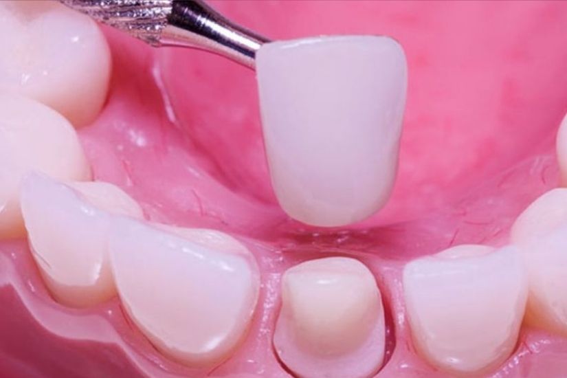 Những nguy cơ rủi ro khi tháo răng sứ làm lại