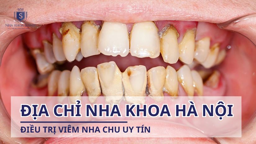 Ở Hà Nội có địa chỉ nha khoa nào điều trị viêm nha chu uy tín?