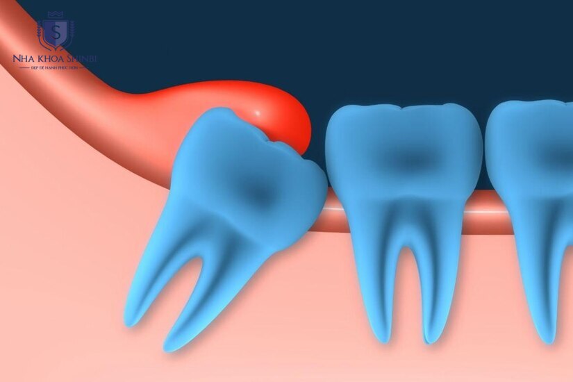 Thiết bị hiện đại giúp giảm cảm giác khó chịu khi nhổ