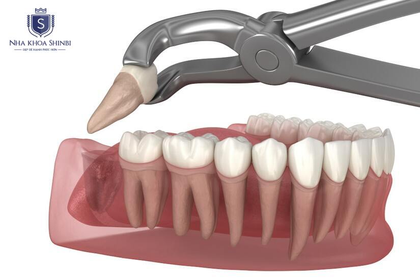 Bác sĩ luôn kiểm tra kỹ trước khi tiến hành nhổ
