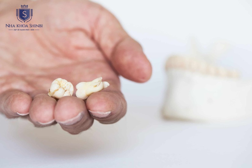 Công nghệ mới giúp kiểm soát tốt quá trình nhổ răng