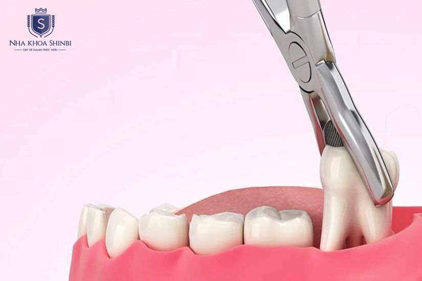 Răng khôn không cần thiết và có thể loại bỏ