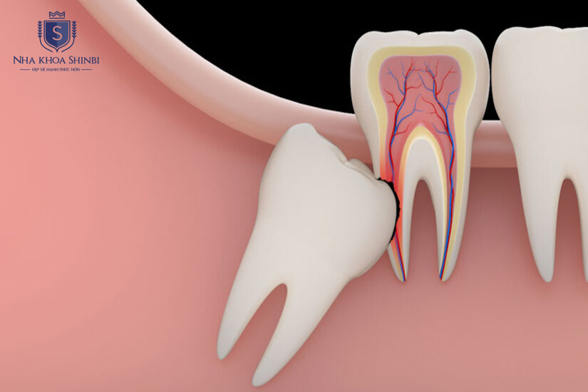 Trước khi nhổ cần kiểm tra tổng quát đầy đủ