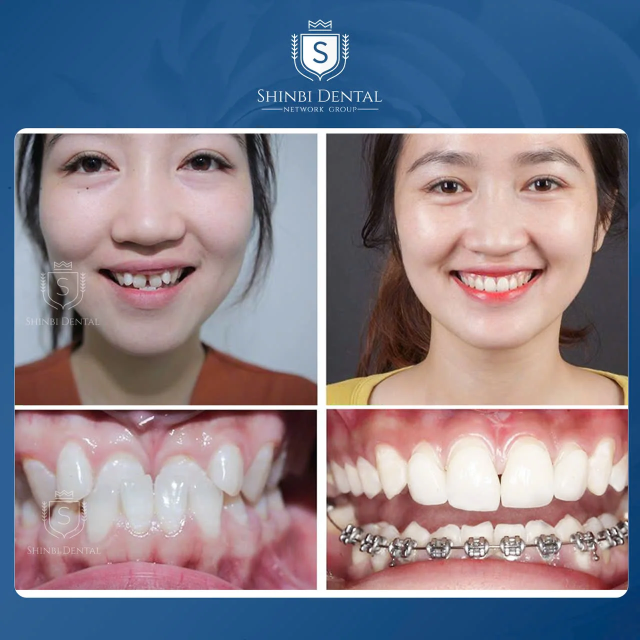 30 câu hỏi FAQ niềng răng - Bác sĩ chỉnh nha giải đáp nhanh cho bạn