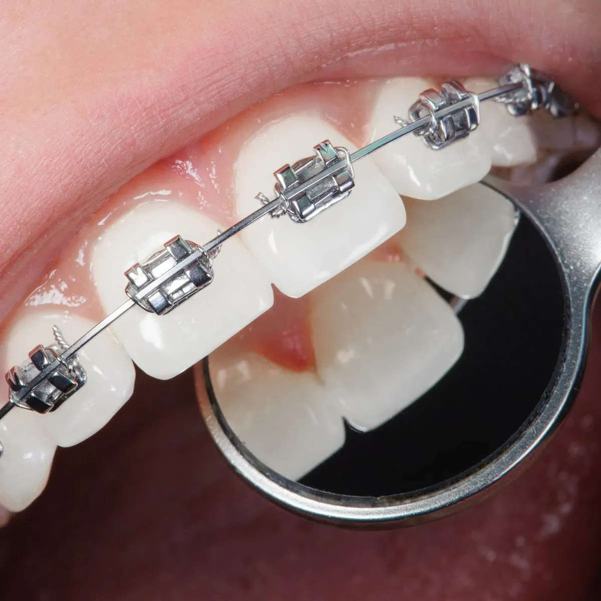 30 câu hỏi FAQ niềng răng - Bác sĩ chỉnh nha giải đáp nhanh cho bạn