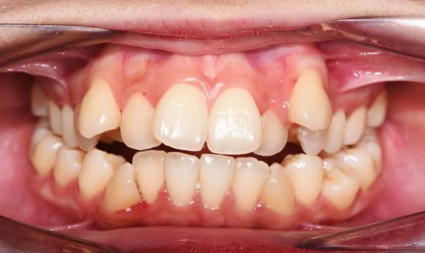 30 câu hỏi FAQ niềng răng - Bác sĩ chỉnh nha giải đáp nhanh cho bạn