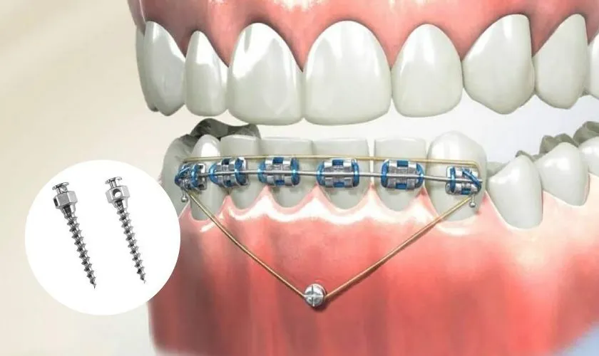 30 câu hỏi FAQ niềng răng - Bác sĩ chỉnh nha giải đáp nhanh cho bạn