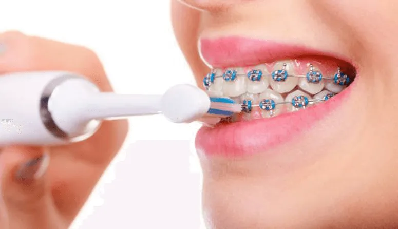 30 câu hỏi FAQ niềng răng - Bác sĩ chỉnh nha giải đáp nhanh cho bạn
