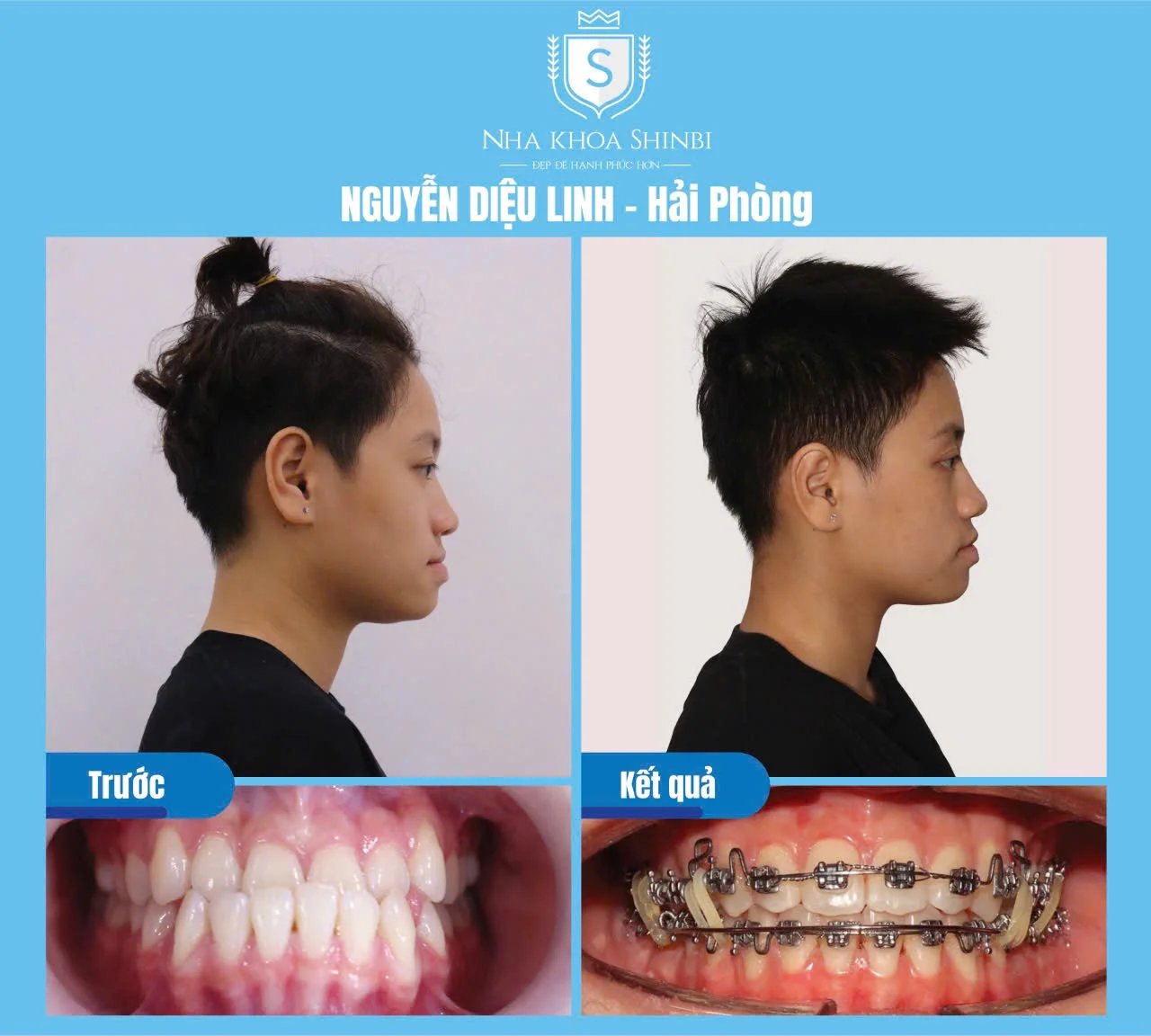 30 câu hỏi FAQ niềng răng - Bác sĩ chỉnh nha giải đáp nhanh cho bạn