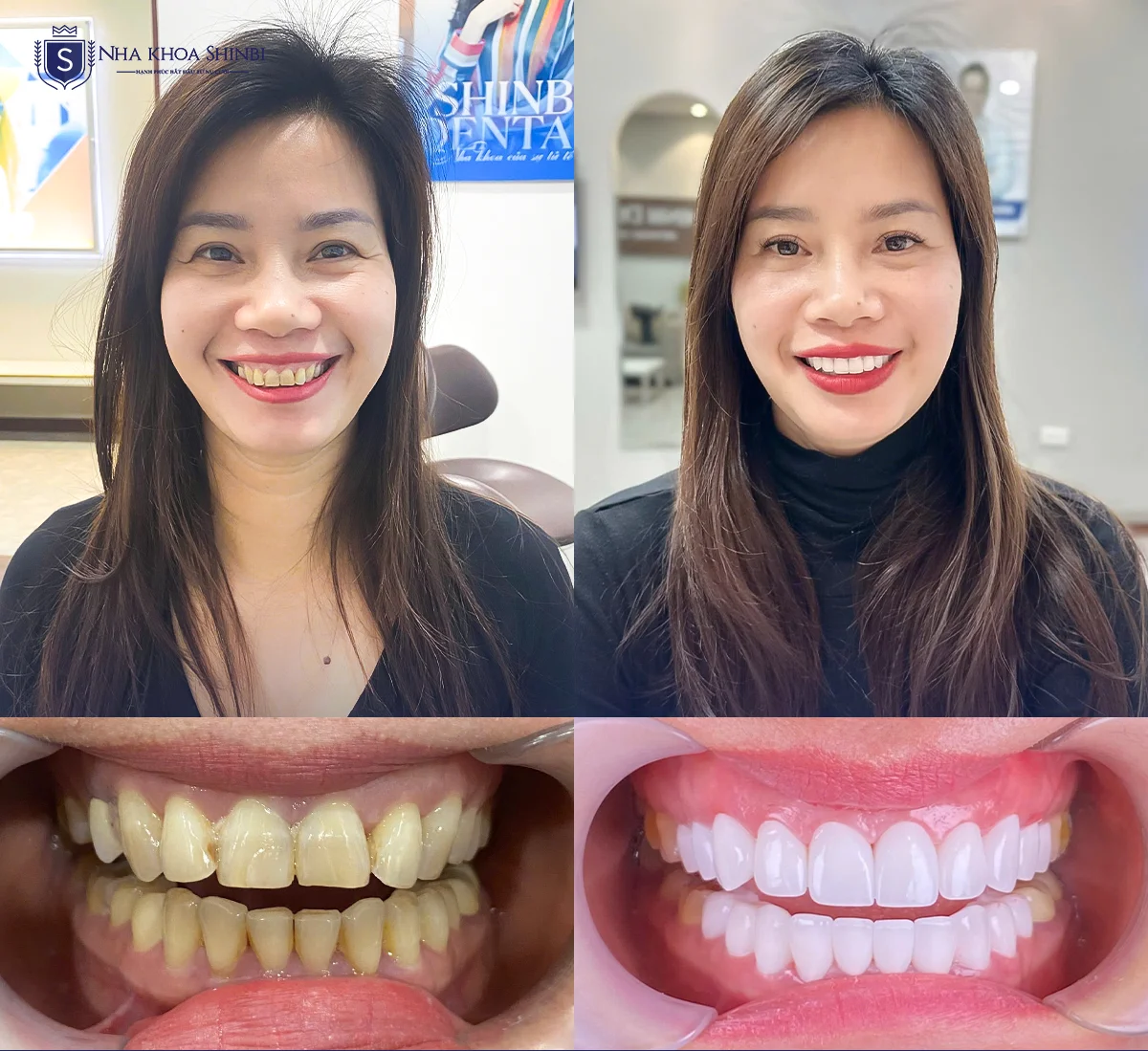 Bảng giá bọc răng sứ mới nhất tại Shinbi (2026) & Chính sách trả góp