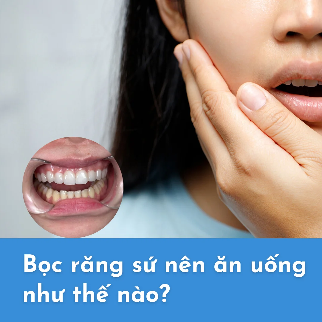 Bọc răng sứ có đau không? Ăn uống ngày Tết thế nào?