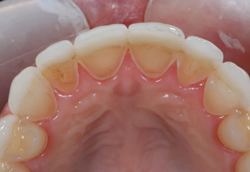 Bọc răng sứ có đau không? Ăn uống ngày Tết thế nào?