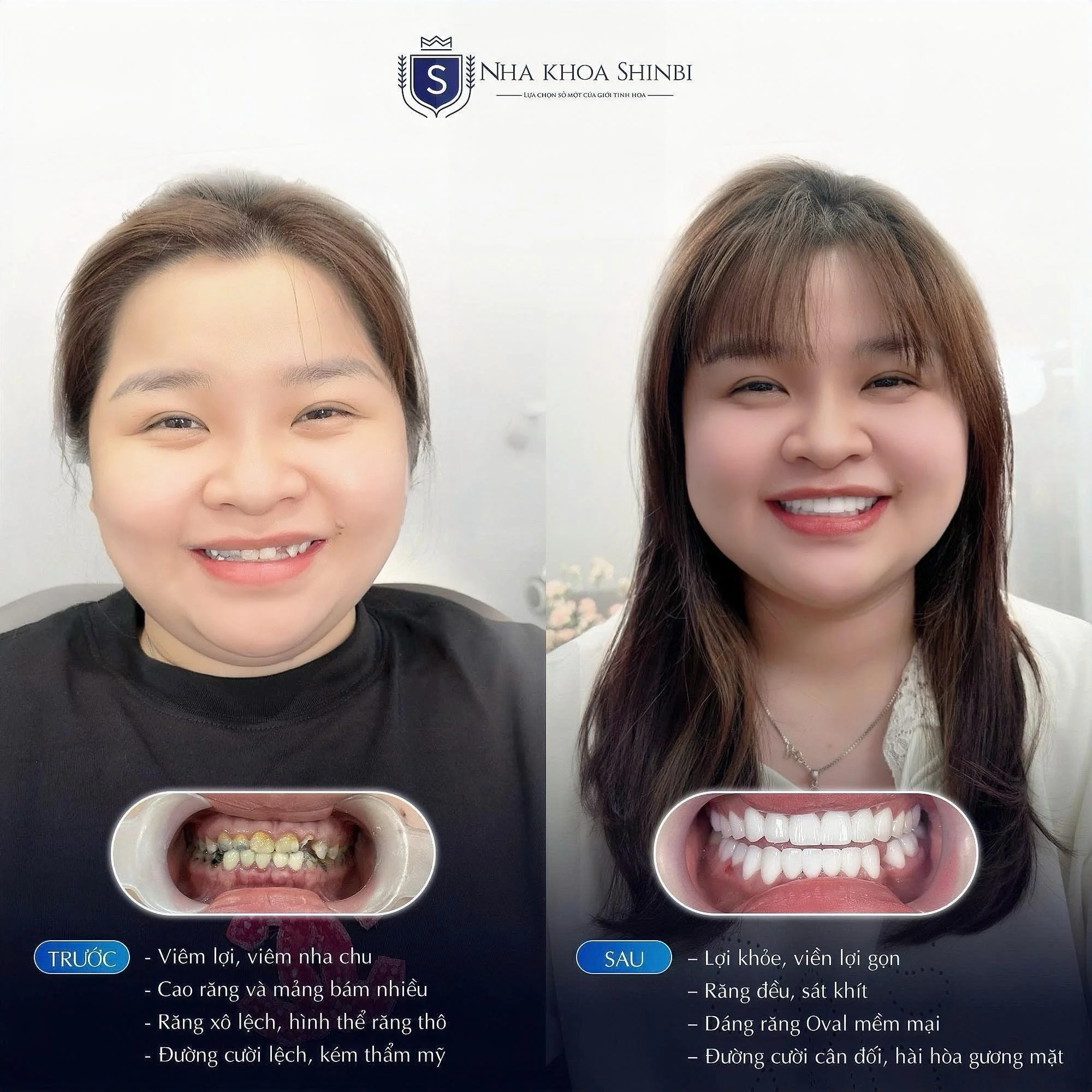 Bọc răng sứ bao nhiêu tiền? Bảng giá mới nhất hiện nay