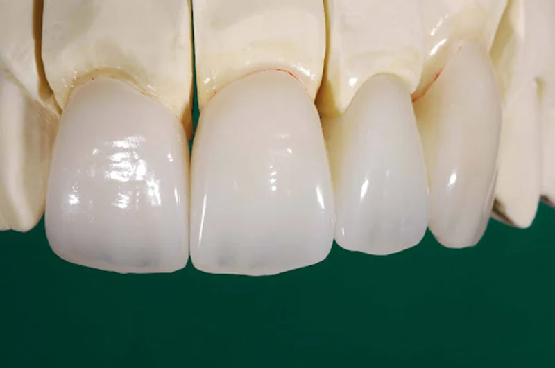 Bọc răng sứ bao nhiêu tiền? Bảng giá mới nhất hiện nay