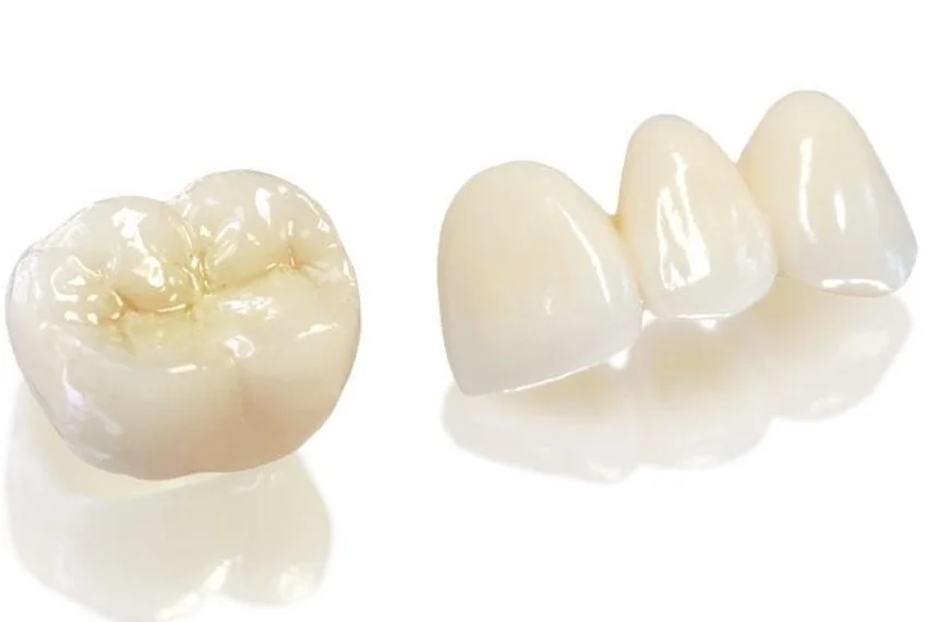 Bọc răng sứ bao nhiêu tiền? Bảng giá mới nhất hiện nay