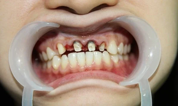 Bọc răng sứ bao nhiêu tiền? Bảng giá mới nhất hiện nay