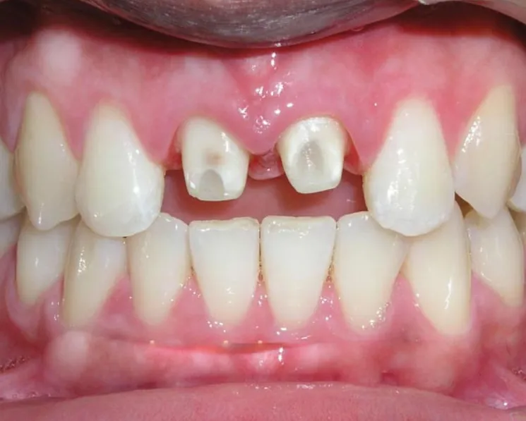 Bọc răng sứ là gì