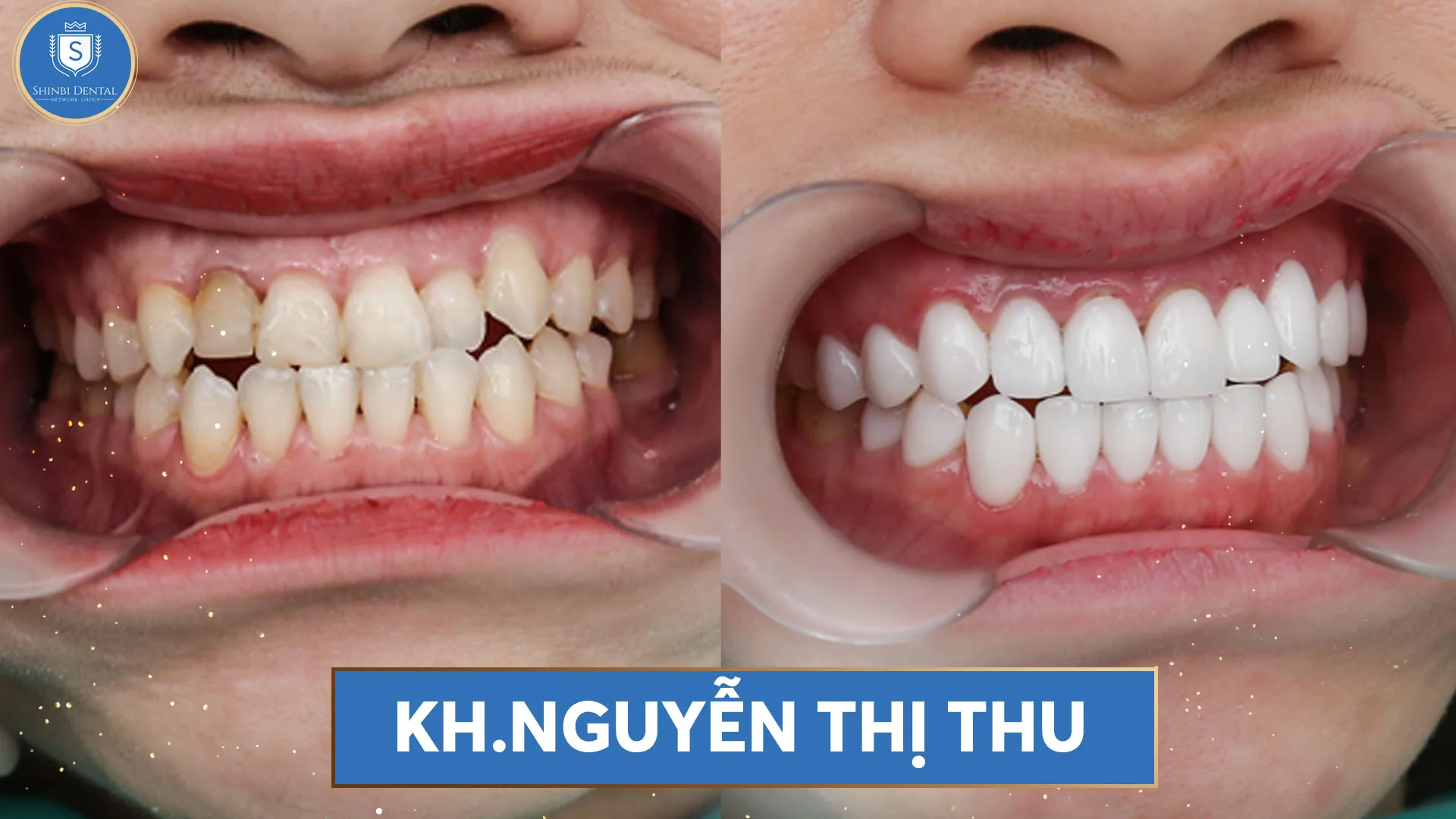 Bọc răng sứ là gì