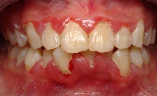 Bọc răng sứ là gì