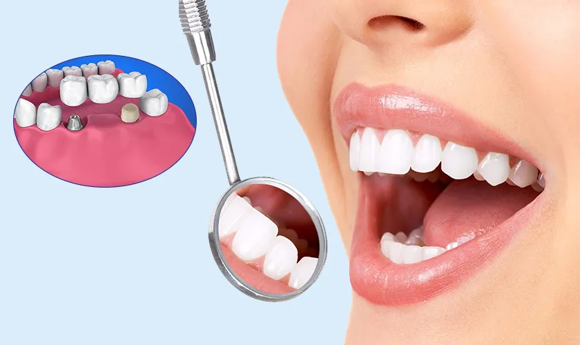 Chi phí bọc răng sứ & điều trị tuỷ – Cập nhật cuối năm