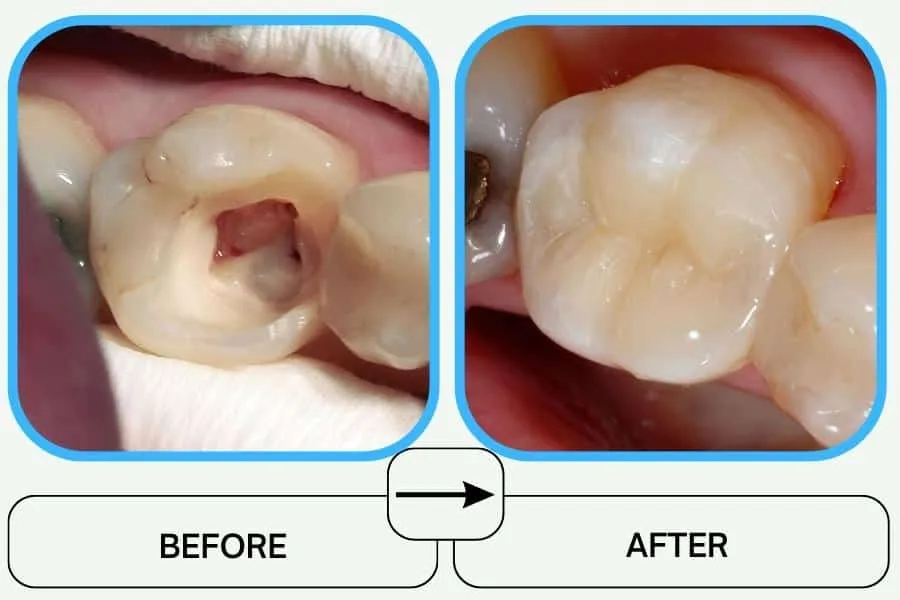 Chi phí bọc răng sứ & điều trị tuỷ – Cập nhật cuối năm