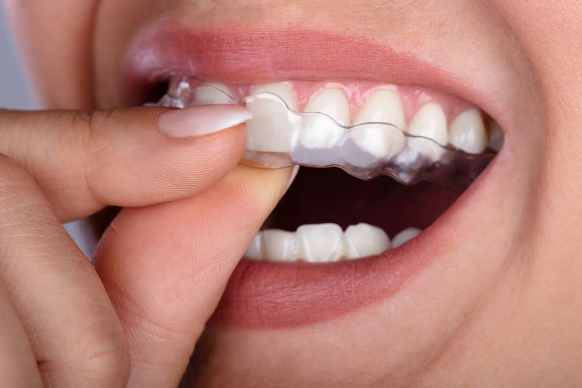 Yếu tố nào làm thay đổi chi phí niềng răng? (7 yếu tố quan trọng)