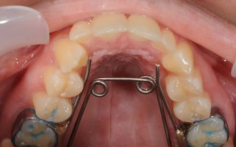 Yếu tố nào làm thay đổi chi phí niềng răng? (7 yếu tố quan trọng)
