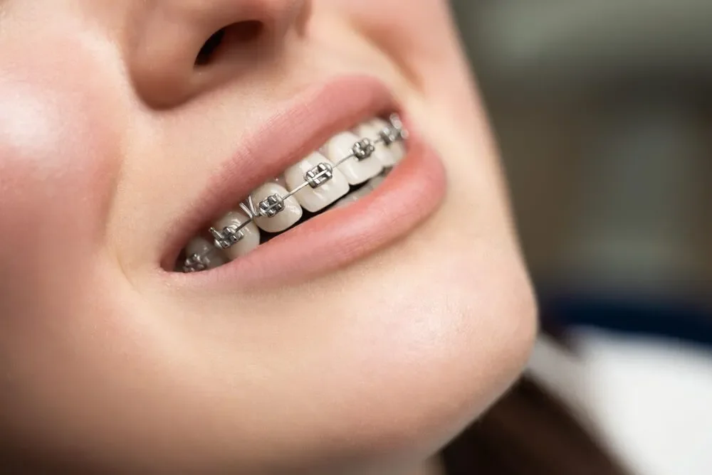 Yếu tố nào làm thay đổi chi phí niềng răng? (7 yếu tố quan trọng)