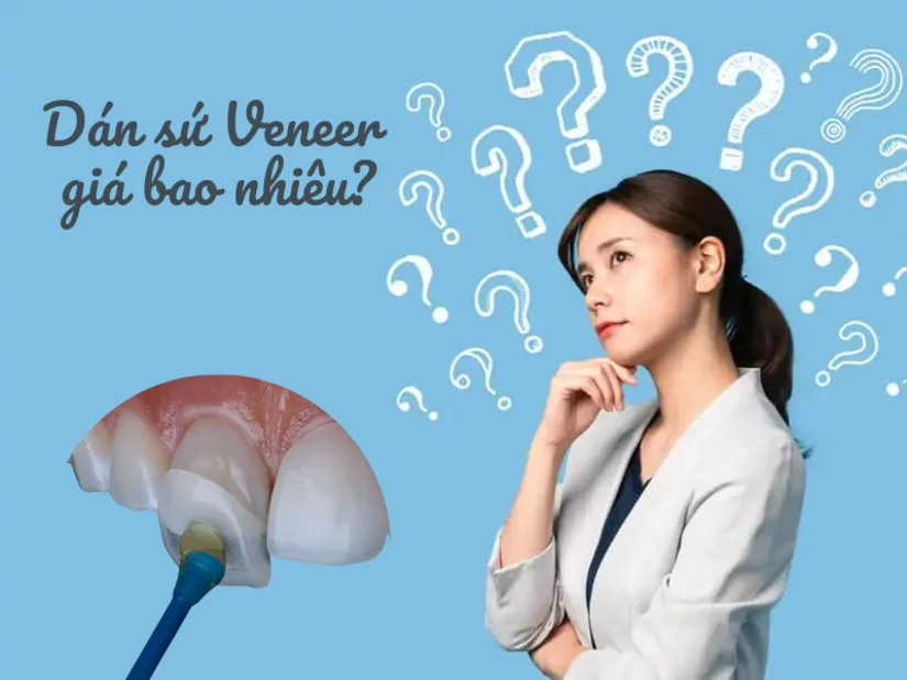 Dán sứ Veneer giá bao nhiêu