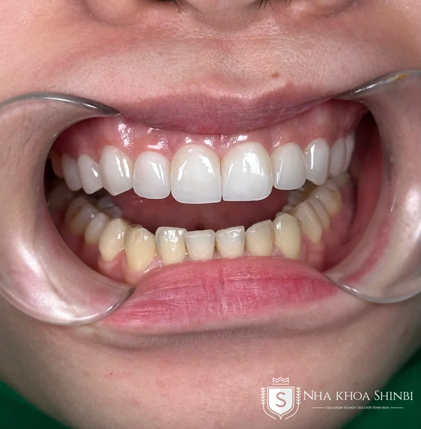 Dán sứ Veneer giá bao nhiêu