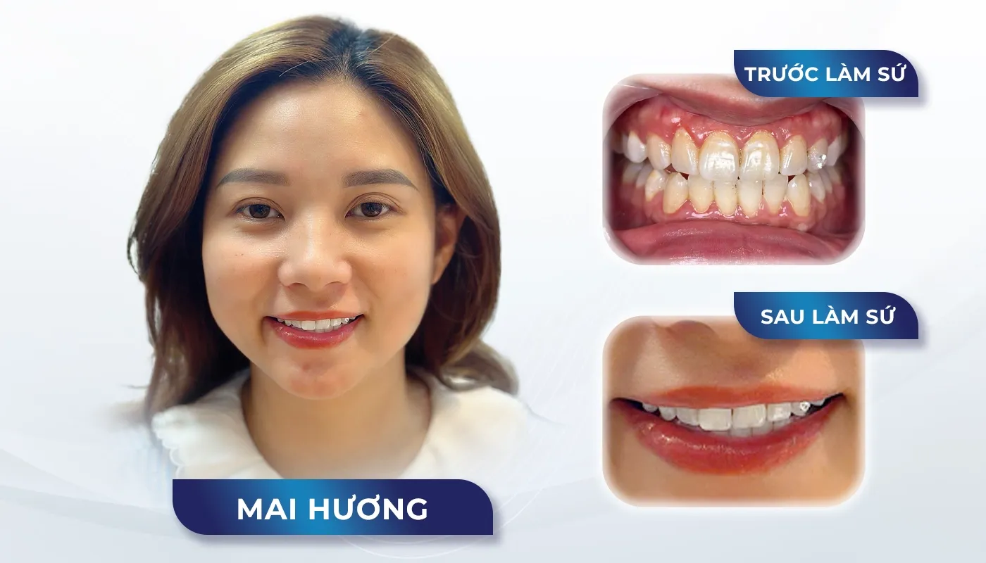 Dán sứ Veneer giá bao nhiêu