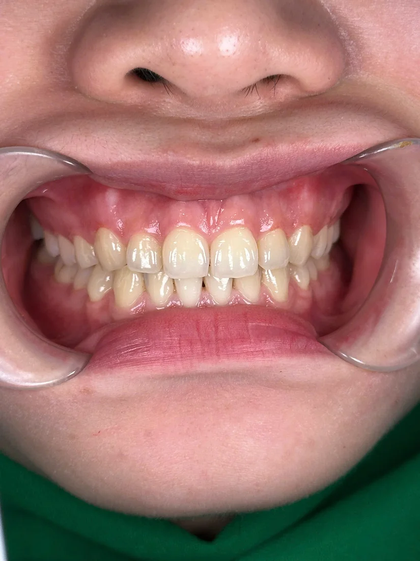 Dán sứ Veneer giá bao nhiêu