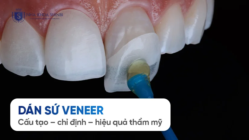 Dán sứ Veneer: cấu tạo – chỉ định – hiệu quả thẩm mỹ