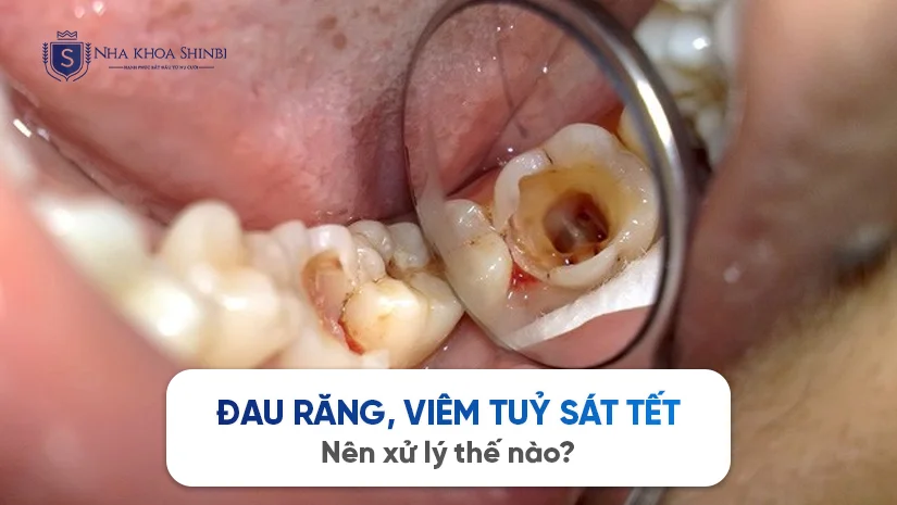Đau răng, viêm tuỷ sát Tết – Nên xử lý thế nào?