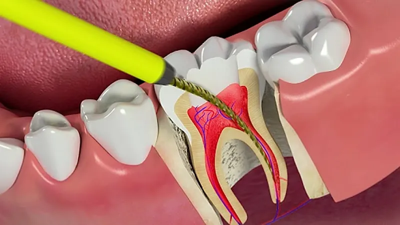 Đau răng, viêm tuỷ sát Tết – Nên xử lý thế nào