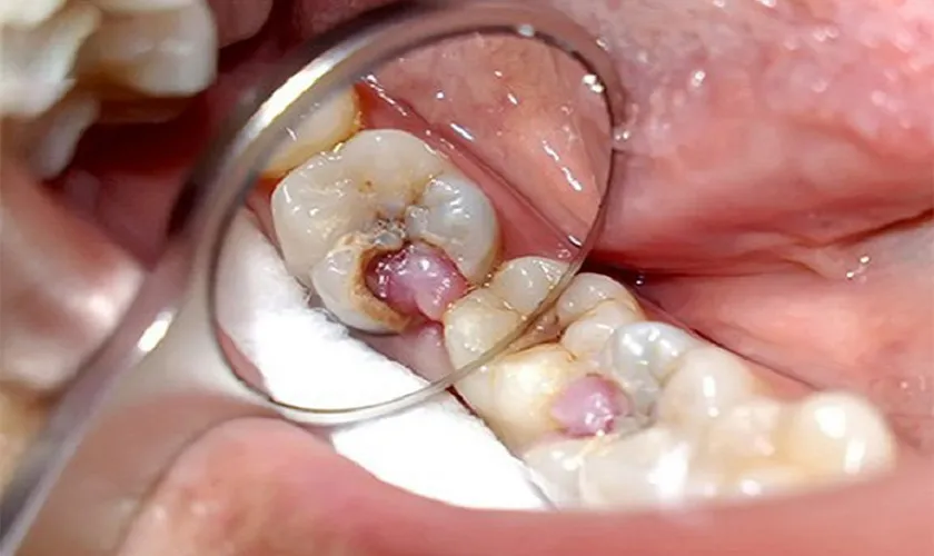 Điều trị tuỷ răng an toàn – Giải quyết đau răng trước Tết