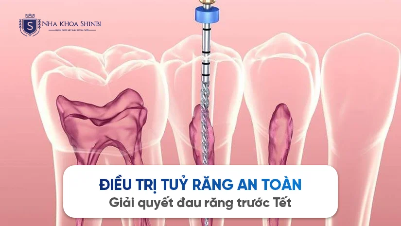 Điều trị tuỷ răng an toàn – Giải quyết đau răng trước Tết
