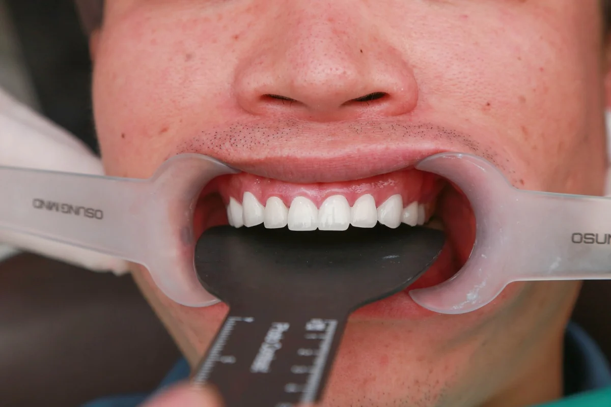 Làm răng sứ trả góp – Giải pháp tài chính nhẹ gánh dịp Tết