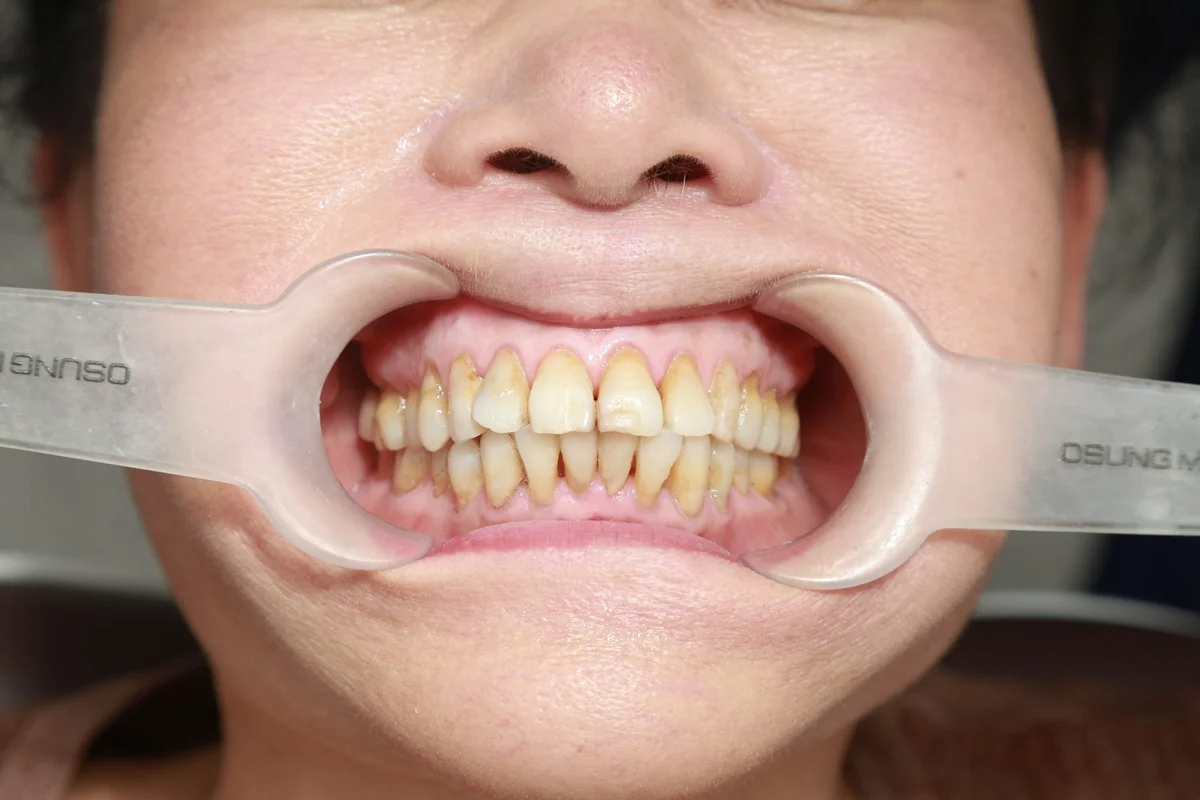 Làm răng sứ trả góp – Giải pháp tài chính nhẹ gánh dịp Tết