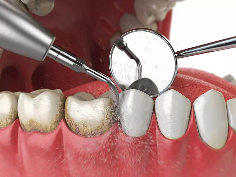 Shinbi Dental - Địa chỉ lấy cao răng sạch, êm ái khu vực Hai Bà Trưng