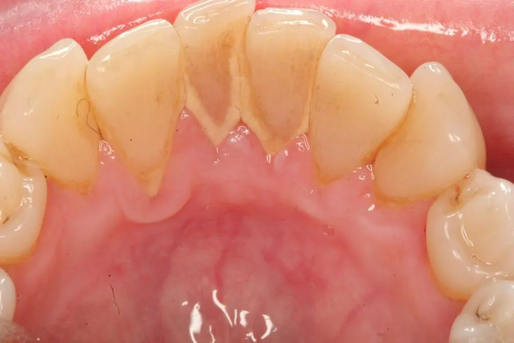Shinbi Dental - Địa chỉ lấy cao răng sạch, êm ái khu vực Hai Bà Trưng