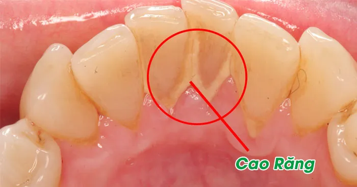 Shinbi Dental - Địa chỉ lấy cao răng sạch, êm ái khu vực Hai Bà Trưng