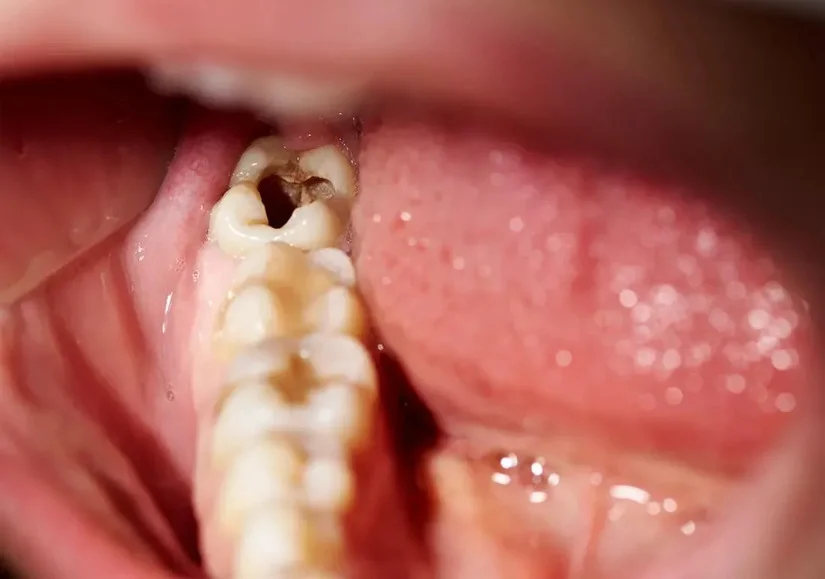 Nhổ răng khôn không đau tại nha khoa khu vực Trần Quốc Toản