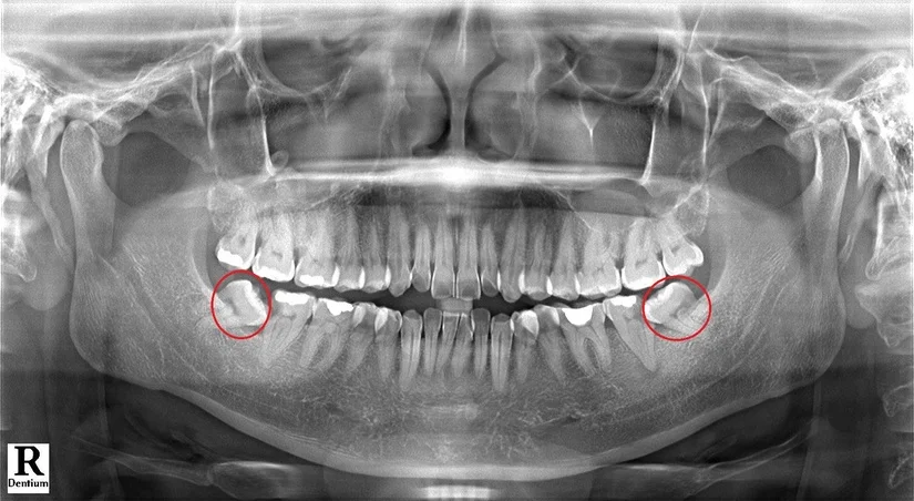Nhổ răng khôn không đau tại nha khoa khu vực Trần Quốc Toản