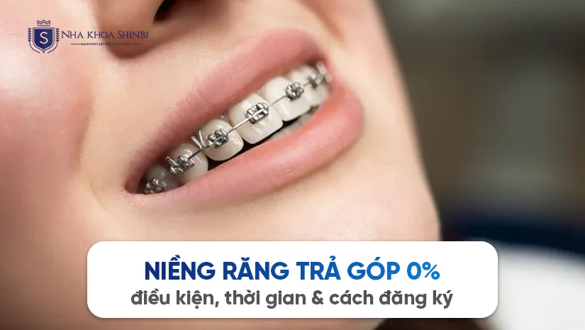 Niềng răng trả góp 0%: điều kiện, thời gian & cách đăng ký