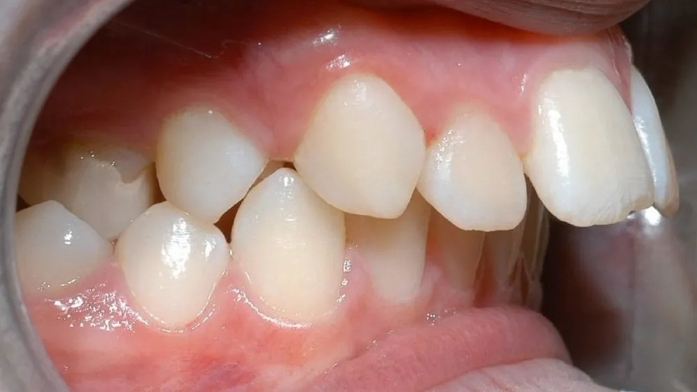 Răng hô khiến môi không khép kín nên chỉnh nha ở đâu tại Hà Nội